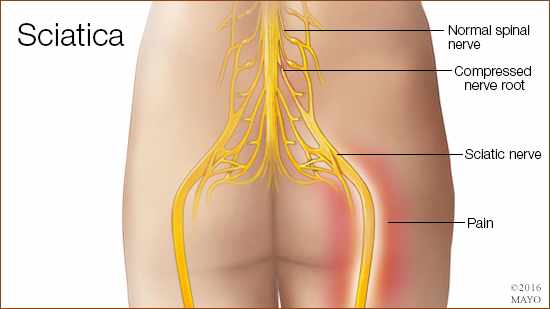 Mayo Clinic Q and A: Sciatica Treatment Options - Mayo Clinic News