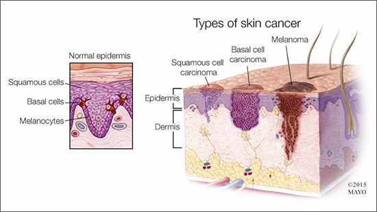a medical illustration of three types of skin cancer - squamous cell, basal cell and melanoma