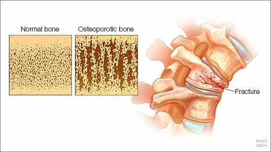 a medical illustration showing healthy bone and osteoporotic bone, as well as a fractured vertebrae
