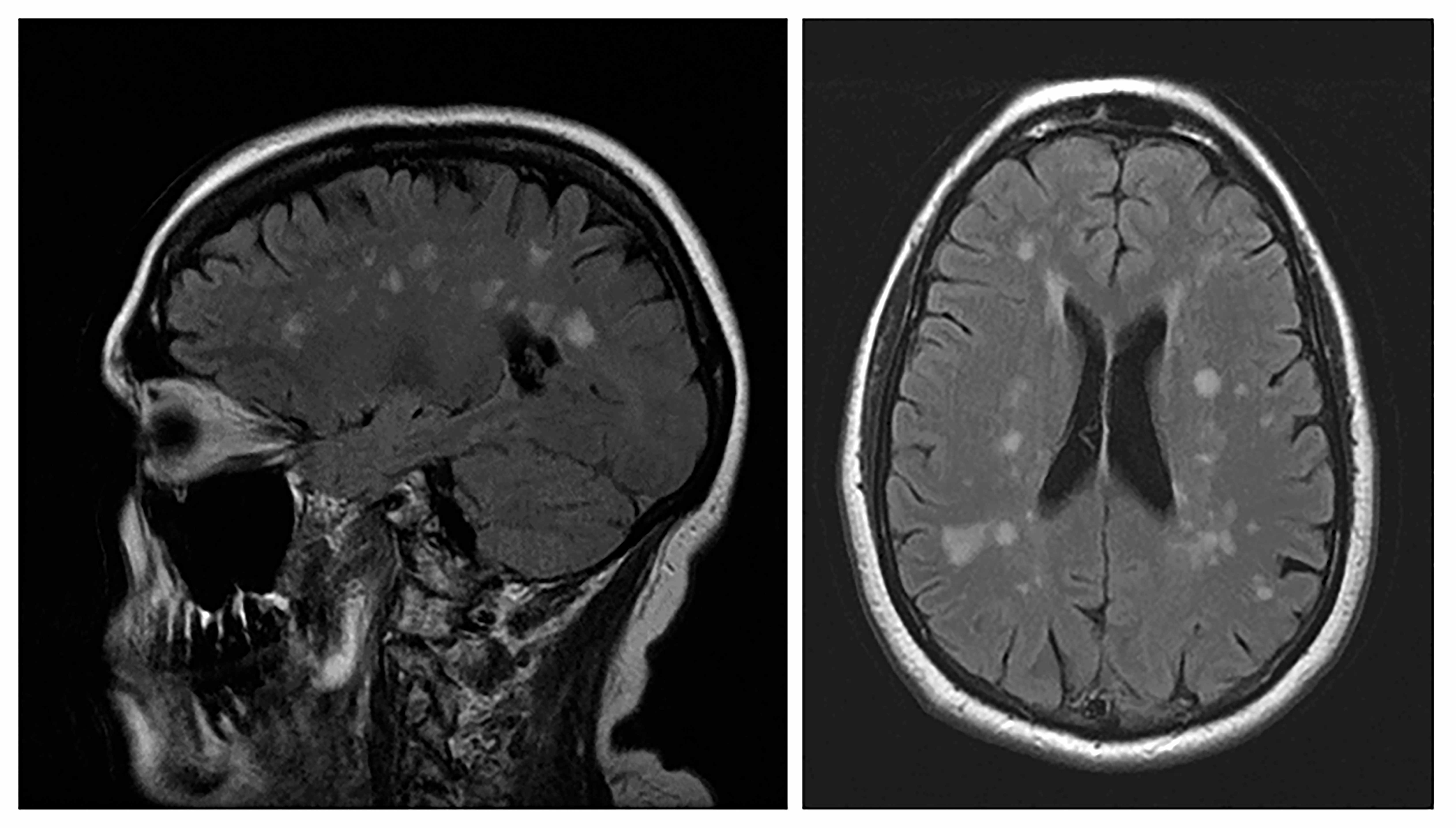 multicenter-study-multiple-sclerosis-misdiagnosis-supports-improved