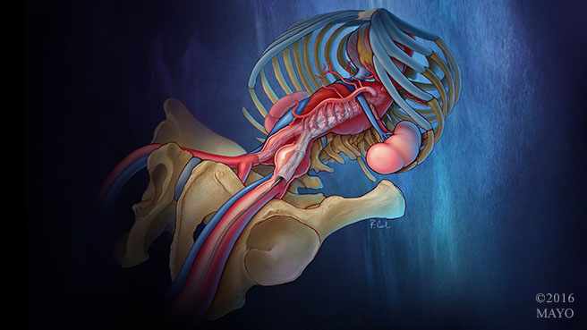 Discovery's Edge medical illustration of aortic-aneurysm