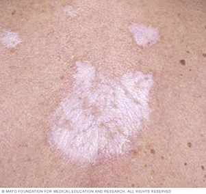 a lichen sclerosus lesion