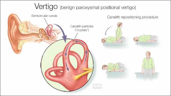a medical illustration of benign paroxsymal positional vertigo (BPPV) and the canalith repositioning procedure