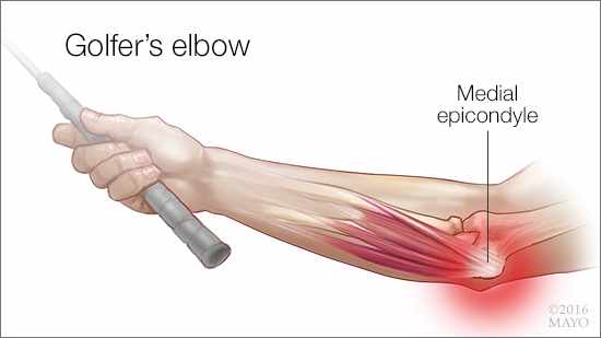 a medical illustration of medial epicondylitis, or golfer's elbow
