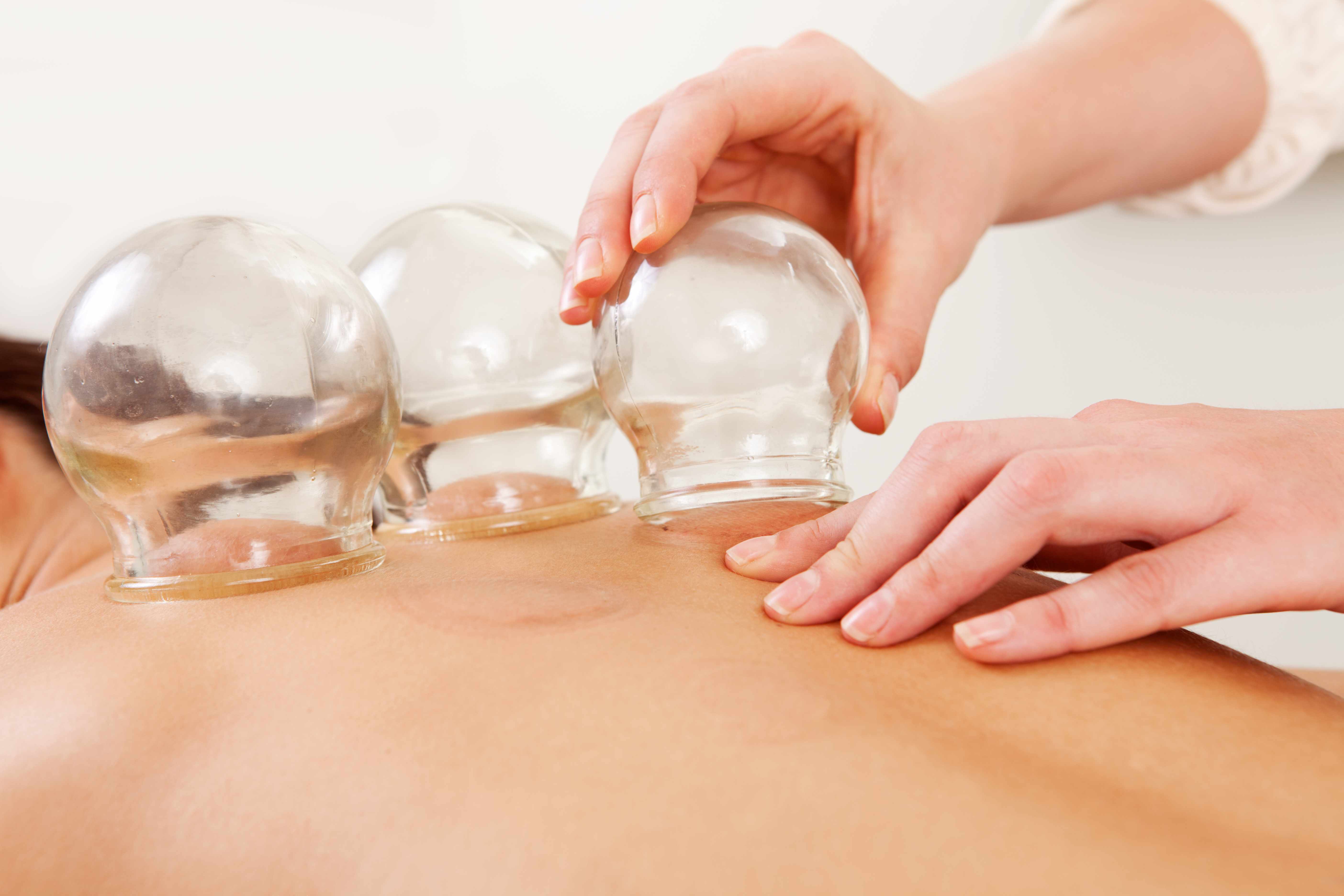 a person doing cupping therapy on someone's back