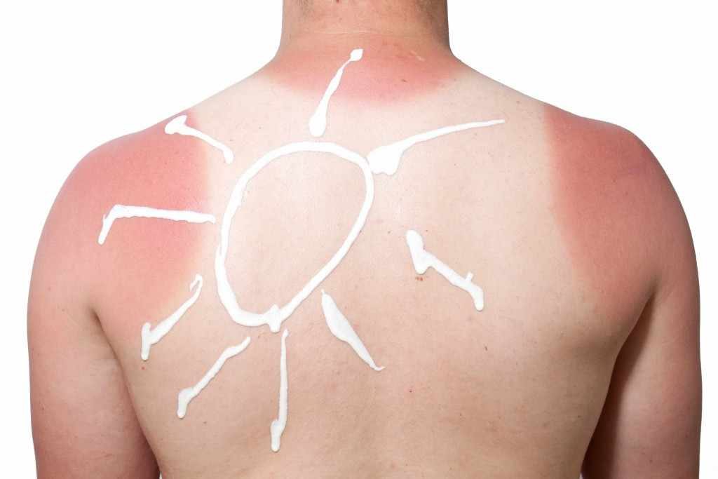 young person's back with sunburn and sunscreen