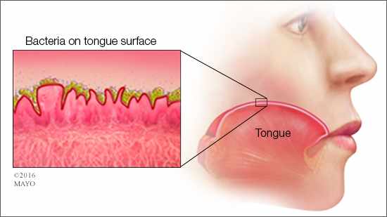 medial illustration of mouth and tongue for bad breath or halitosis