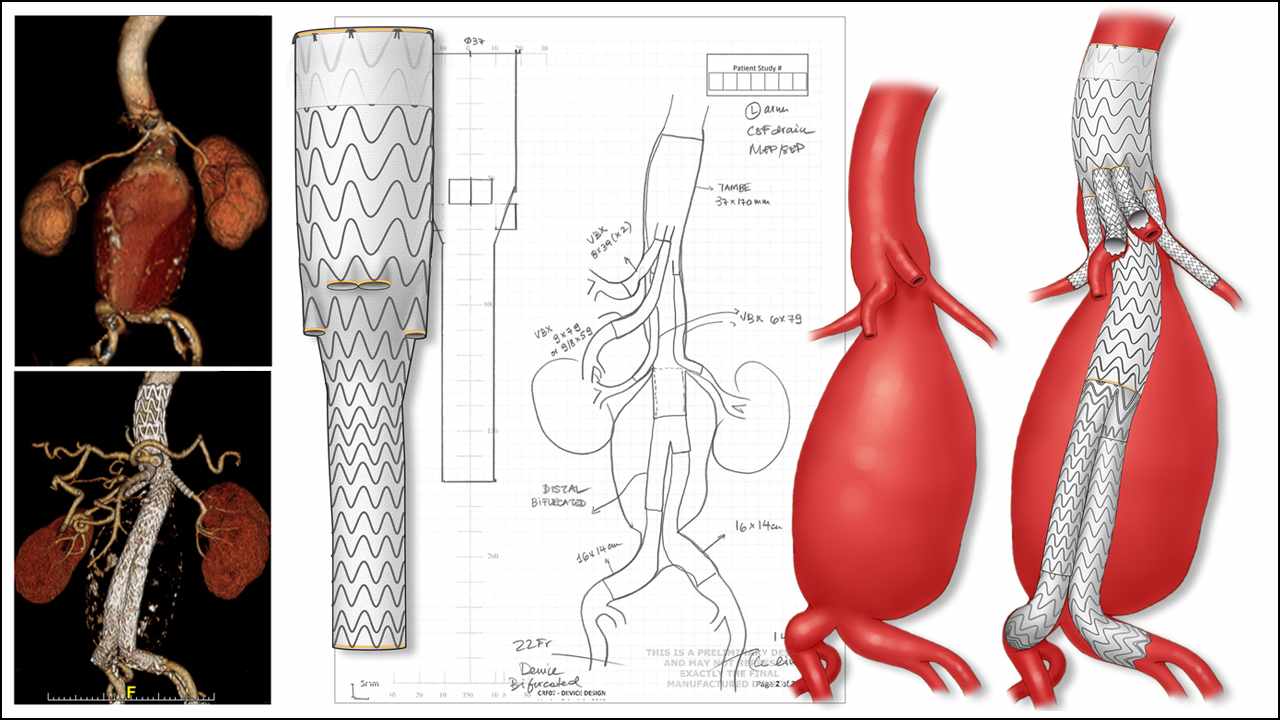 Ilustración de la planificación quirúrgica de un paciente tratado con uno de los primeros implantes para humanos del injerto y estent Gore TAMBE para tratar un aneurisma aórtico complejo.