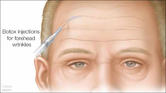 Ilustración médica de las inyecciones de bótox para las arrugas en la frente