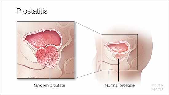 Ilustración médica de la prostatitis: una próstata hinchada (izquierda) y una próstata normal (derecha)