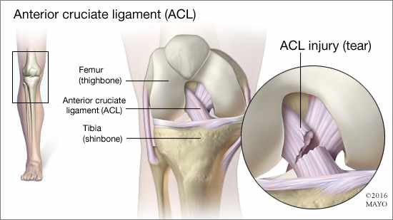 a medical illustration of the anterior cruciate ligament (ACL) and an ACL injury