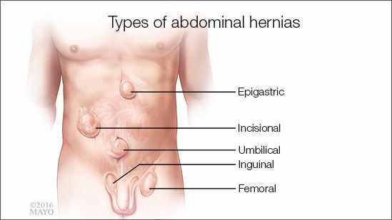 Ilustración médica de los tipos de hernias abdominales