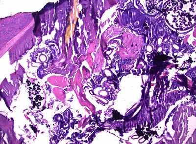 a slide of an unidentified H&E-stained section of a curetted lesion from the Parasite Wonders blog