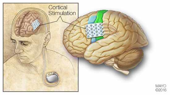 Ilustración médica de la estimulación cortical