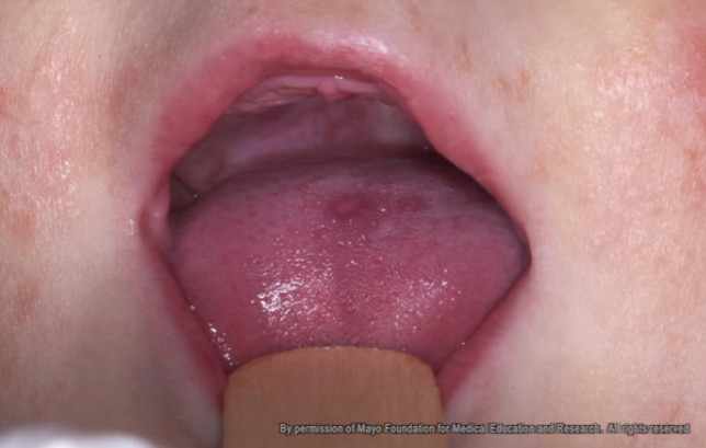 close up of child's open mouth showing hand foot and mouth disease