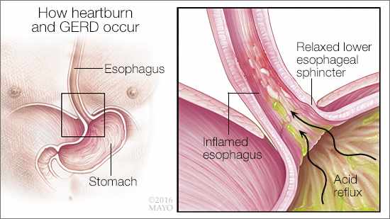 medical illustration of heartburn and GERD