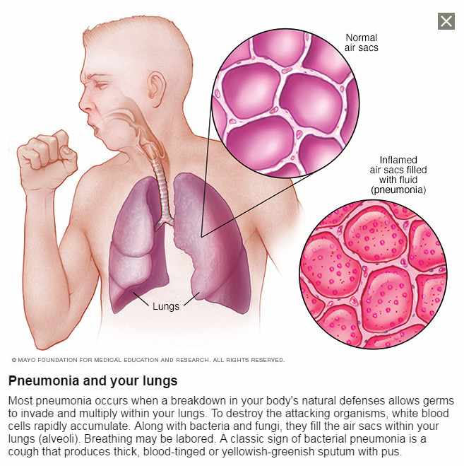 a medical illustration of a person coughing and battling inflamed air sacs because of pneumonia