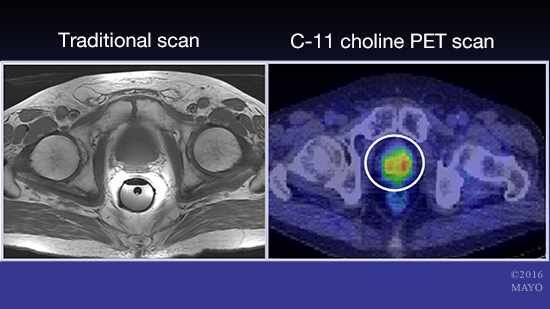 Imagen de la próstata y de la exploración por PET y 11C-colina (sobre la derecha)
