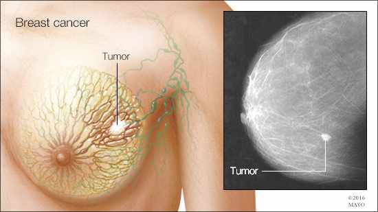 a medical illustration and radiologic image of breast cancer