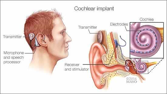 Ilustración médica de un implante coclear