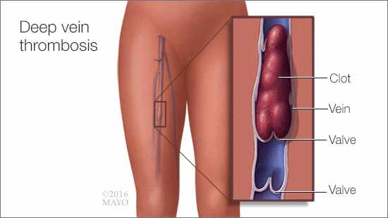 Ilustración médica de la trombosis venosa profunda