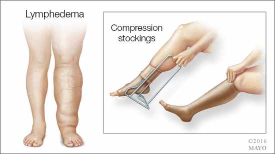 Ilustración médica del linfedema en la pierna y de la aplicación de las medias de compresión
