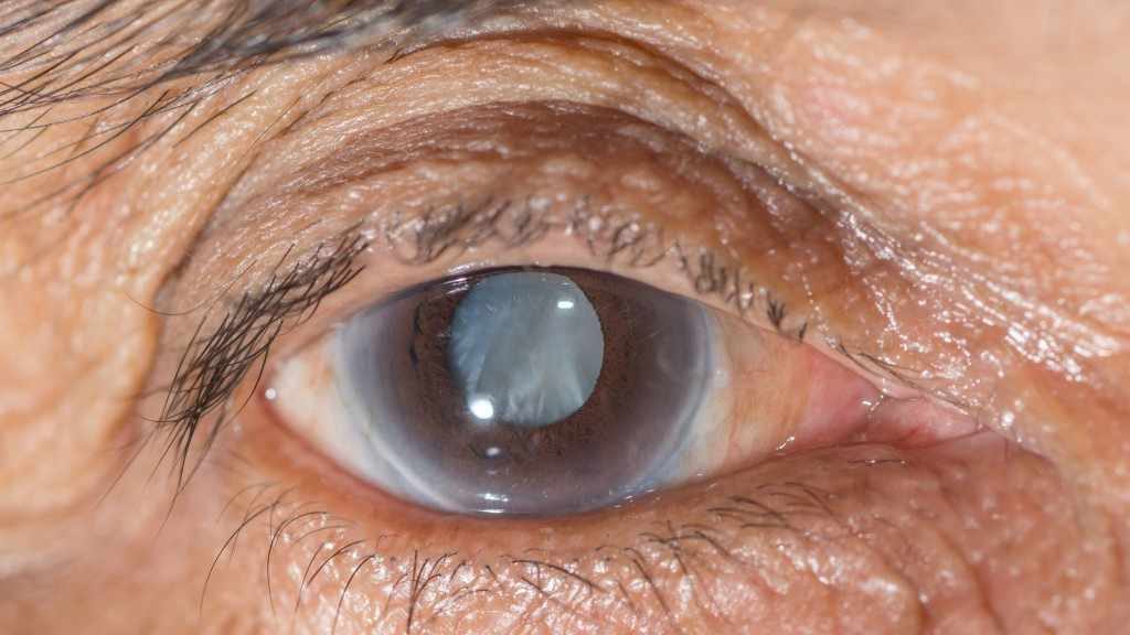 closeup of person's eye with cloudy vision cataract