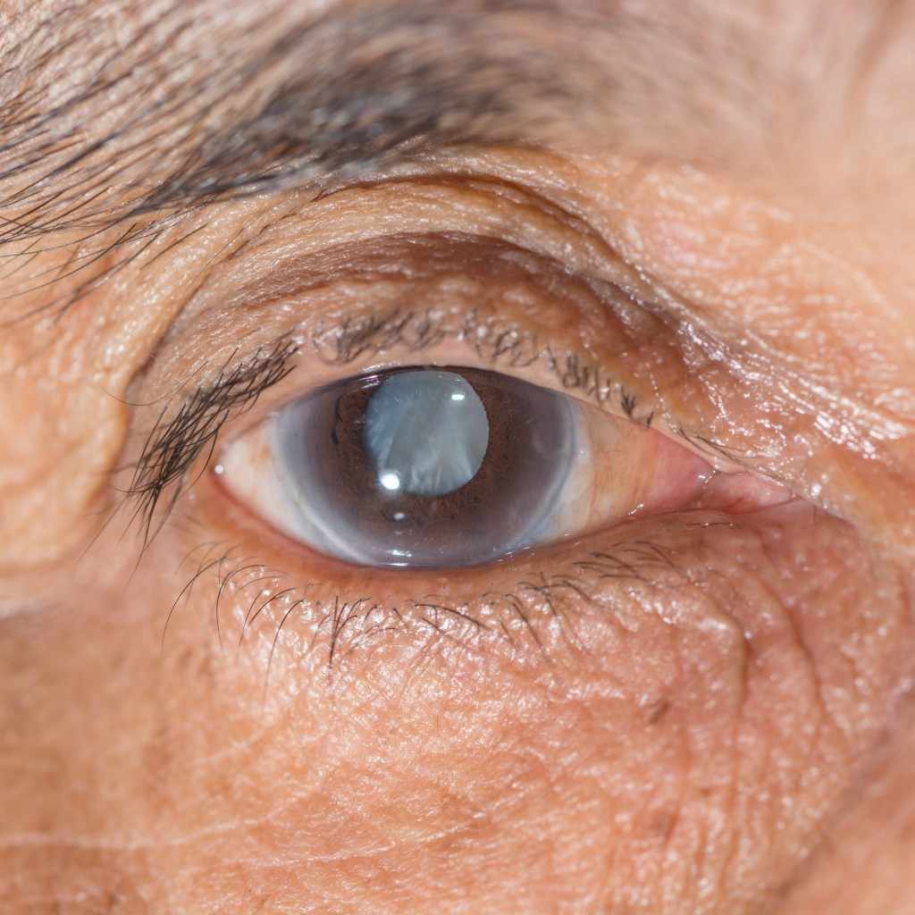 closeup of person's eye with cloudy vision cataract