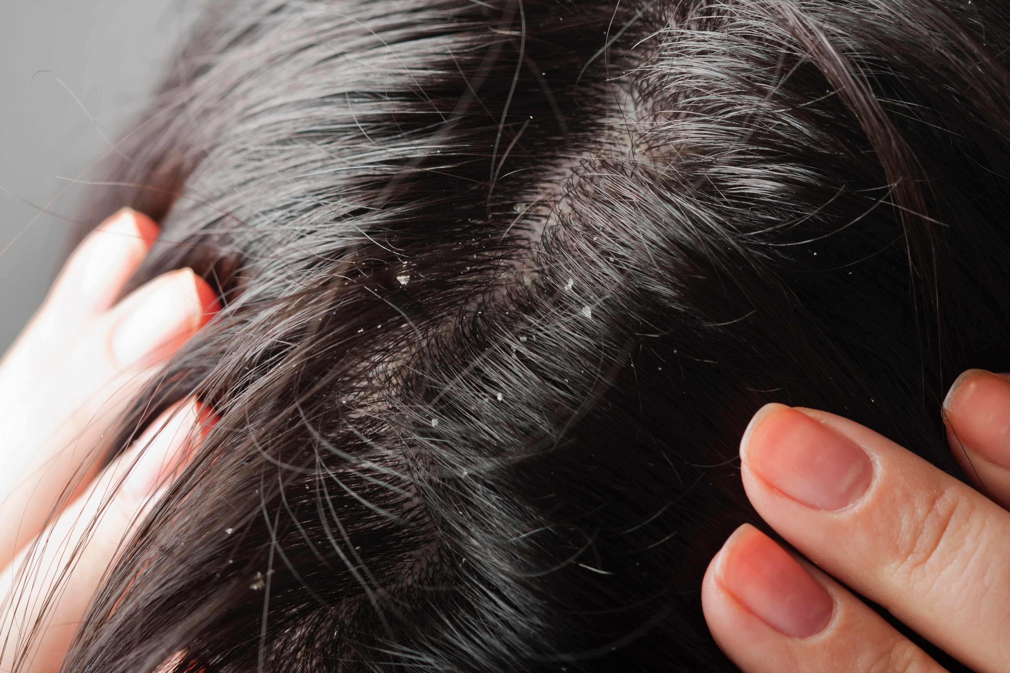 a woman with dark brown or blach hair showing the dandruff on her scalp