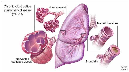 a medical illustration of Chronic obstructive pulmonary disease COPD