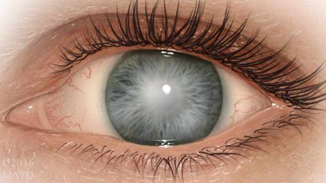 medical illustration of the cornea in the eye with clouding