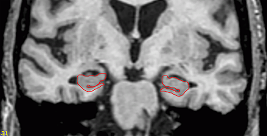 Study Lack of brain shrinkage may help predict who develops dementia
