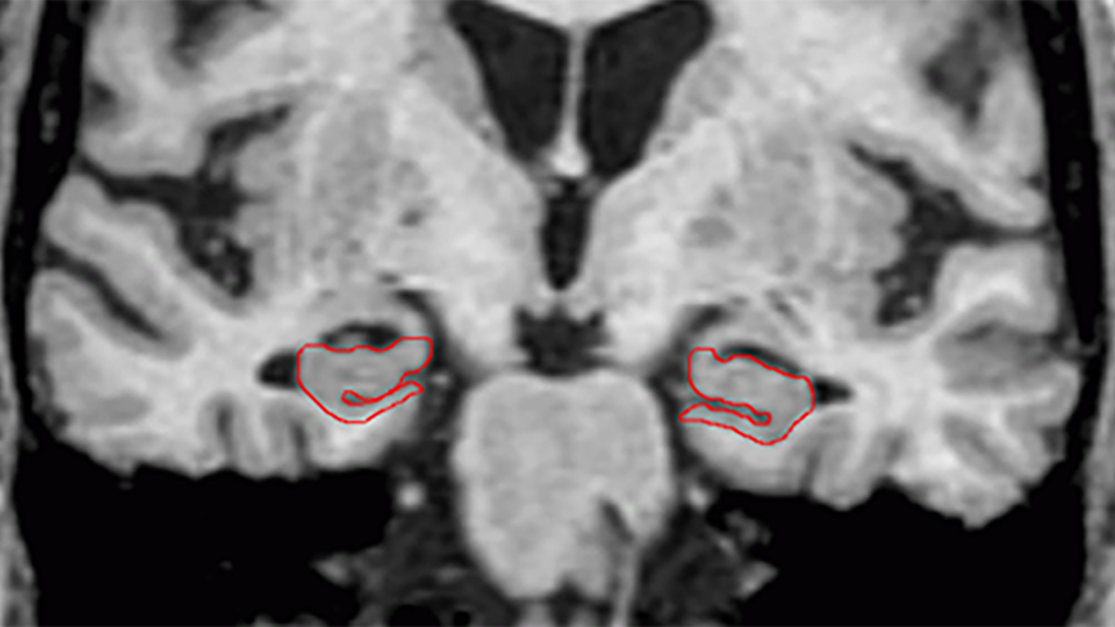 Una resonancia magnética muestra las regiones derecha e izquierda del hipocampo estudiadas en el cerebro 