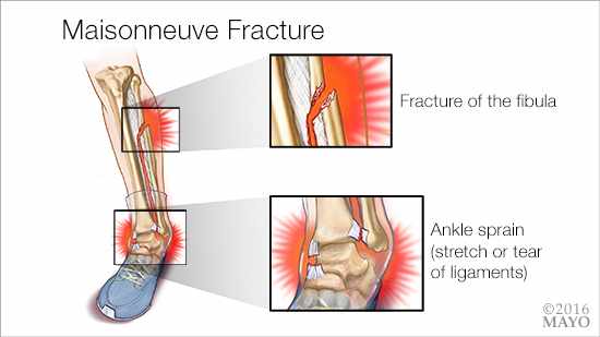 a medical illustration of a Maisonneuve fracture