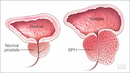 Ilustración médica de una próstata normal y de otra con hipertrofia benigna de próstata