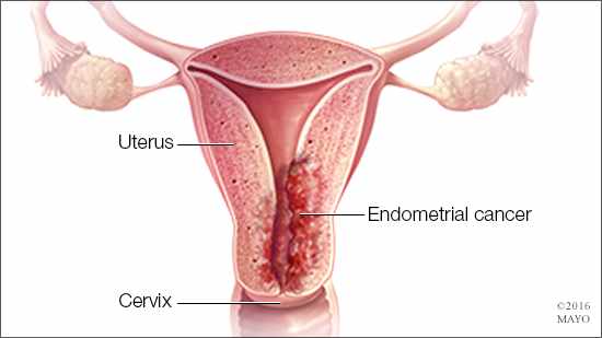 Ilustración médica del cáncer de endometrio