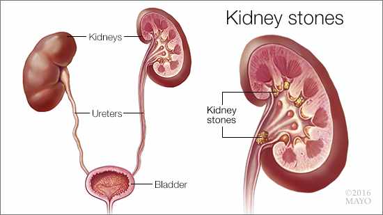 kidney-stones-16x9