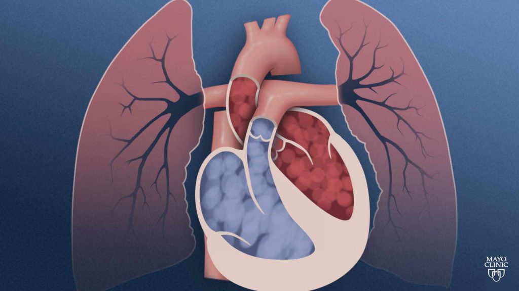 Mayo Clinic Minute: Under pressure with pulmonary hypertension - Mayo  Clinic News Network