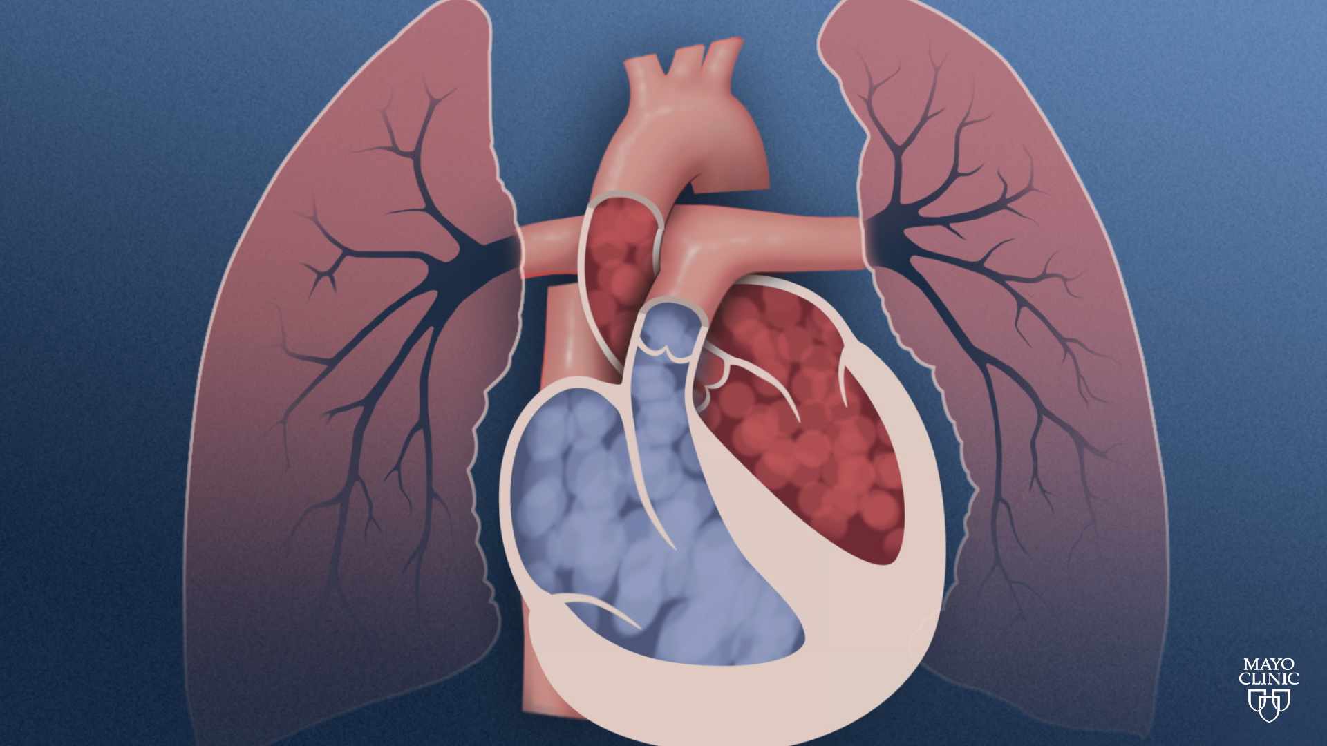 Mayo Clinic Minute: Under pressure with pulmonary hypertension - Mayo