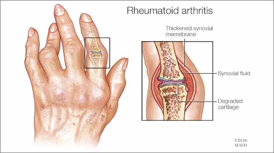 Ilustración médica de la artritis reumatoide