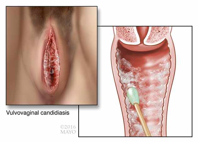 medical illustration of vaginal yeast infection vulvovaginal-candidiasis