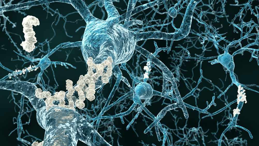 Ilustración médica de las placas amiloides en la enfermedad de Alzheimer