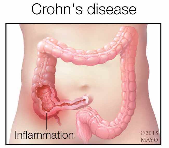 medical illustration of Crohn's disease inflammation