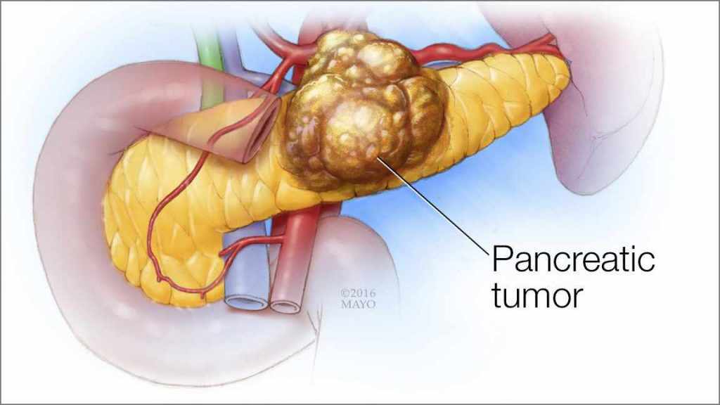 Medical illustration of pancreatic cancer with a tumor on the pancreas