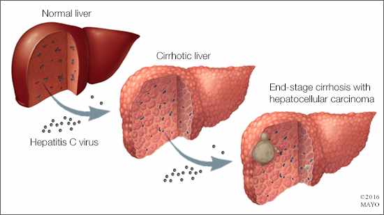 Living With Cancer: Hepatocellular carcinoma - Mayo Clinic News Network
