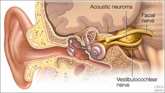 Ilustración médica de un neuroma acústico
