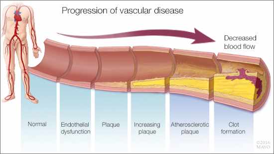 a medical illustration of the progression of vascular disease
