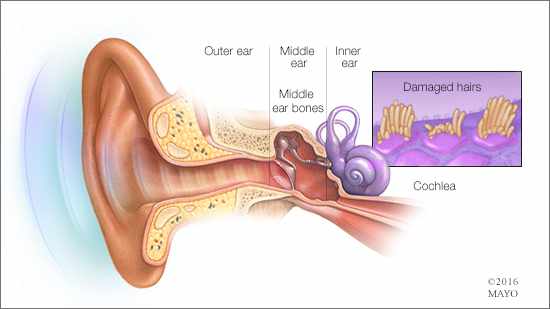Ilustración médica de la anatomía del oído y de la pérdida de la audición
