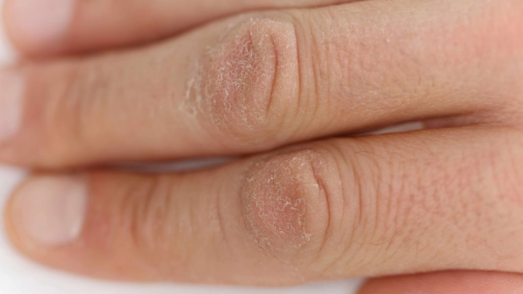 a persons fingers with dry cracked skin from winter
