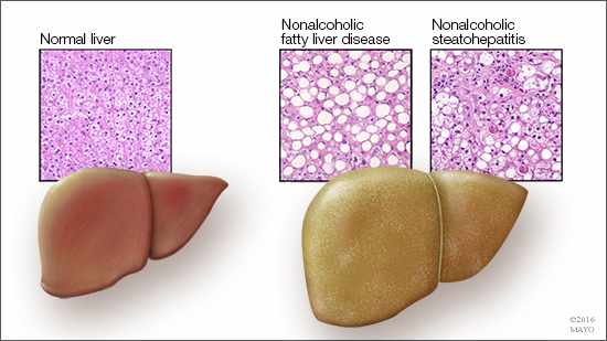 Ilustración médica de un hígado normal y de otro graso